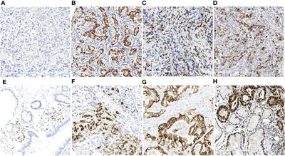 Clinicopathological and Immunomicroenvironment Characteristics of Epstein–Barr Virus-Associated Gastric Cancer in a Chinese Population